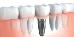 Washington DC Dentist | Implant Dentist | Dr. Price 